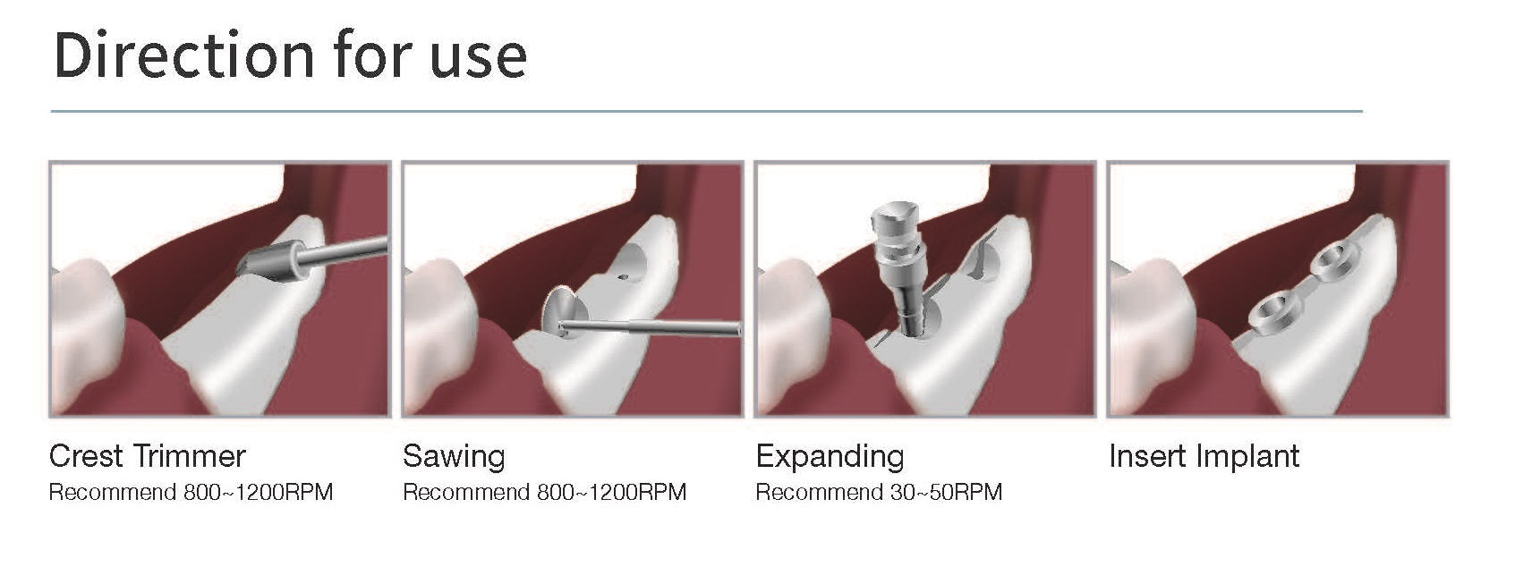 SIS Bone Expander Kit