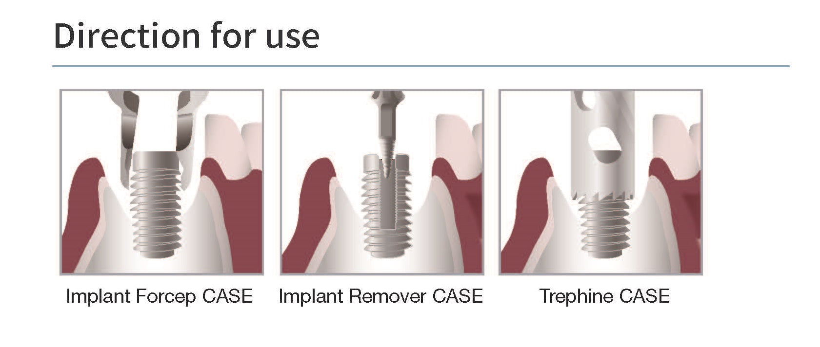 SIS Fixture Remover Kit