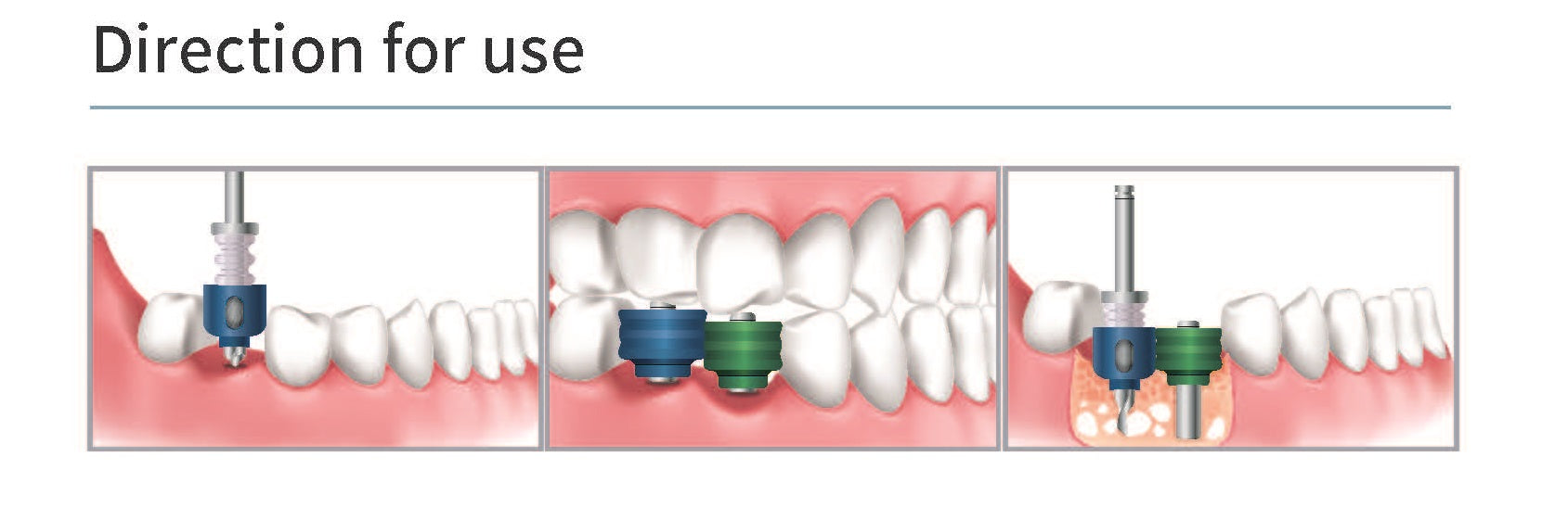 SIS Implant Guide Kit